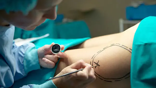 Un intervento di liposuzione - Foto © www.giornaledibrescia.it