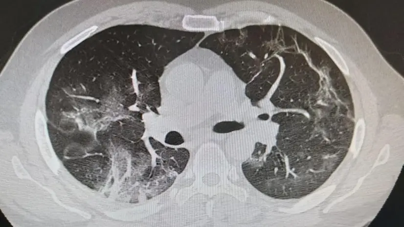 I polmoni durante l'infezione -  © www.giornaledibrescia.it