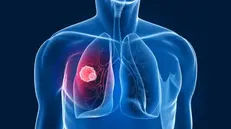 Il tumore del polmone è la prima causa di morte tra gli uomini in Italia - © www.giornaledibrescia.it