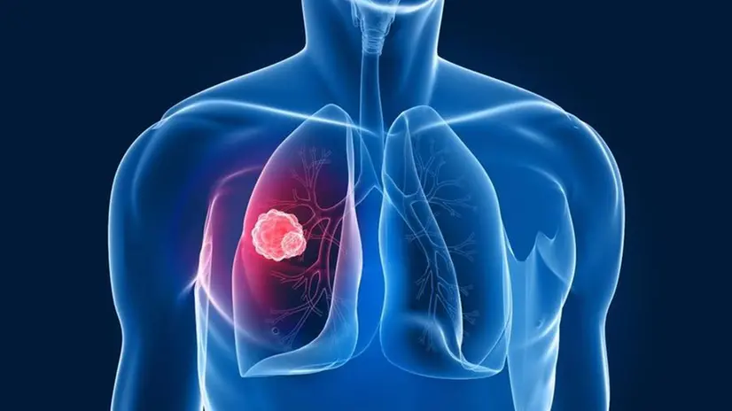 Il tumore del polmone è la prima causa di morte tra gli uomini in Italia - © www.giornaledibrescia.it