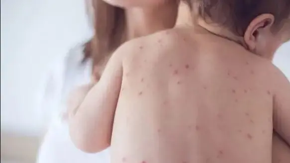 I puntini sono il segno più evidente del morbillo © www.giornaledibrescia.it