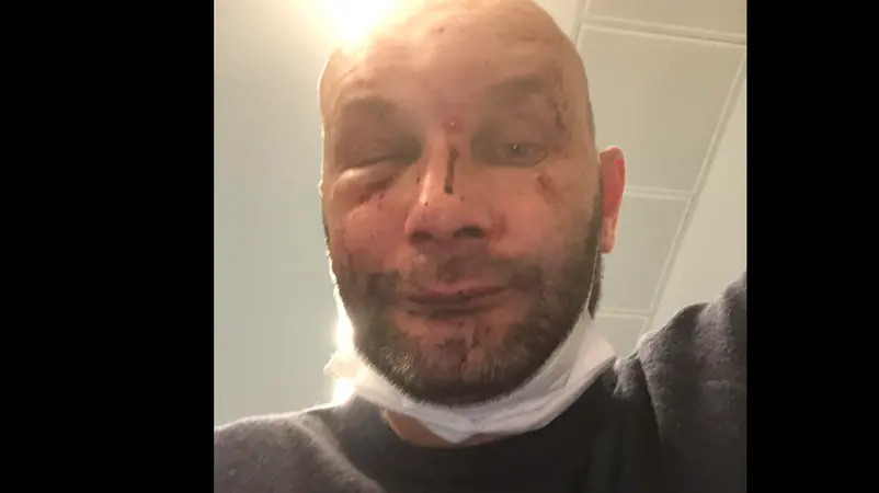 La foto pubblicata dal 43enne su Facebook, scattata in ospedale dopo l'aggressione - Foto tratta da Fb