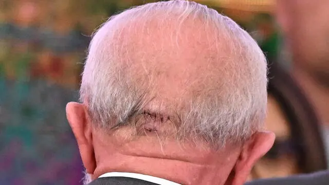 epa11683127 A close up view of a head injury of Brazilian President Luiz Inacio Lula da Silva, as he attends the signing of the renegotiation of the Mariana Disaster Conduct Adjustment Transaction agreement, at the Palacio do Planalto in Brasilia, Brazil, 25 October 2024. The Brazilian government on 25 October has signed with the mining companies Vale and BHP an agreement for the 'comprehensive and definitive repair' of the disaster caused in 2015 by the collapse of a dam, which left 19 dead and an environmental catastrophe in the state of Minas Gerais. EPA/AndrÃ© Borges