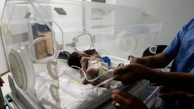 epa09472059 Yemeni doctors care for two-headed conjoined twin female babies inside an incubator a few hours after they were born at the neonatal intensive care unit of a hospital in Sana'a, Yemen, 16 September 2021. A Yemeni woman, 27, gave birth to two twin girls who are physically joined together at the chest, abdomen and pelvis. The two conjoined girls are in one body with two heads, two backbones and share the pelvis and limbs of three hands and three legs. The newborn twins, born to a Yemeni couple who live in Sana’a, are in fairly stable health so far, doctors in charge of the case at a Sana'a hospital said. The two-headed female body is a rare and complicated medical predicament requiring urgent medical treatment abroad as the medical capabilities in war-ridden Yemen are very poor, the doctors added. EPA/YAHYA ARHAB