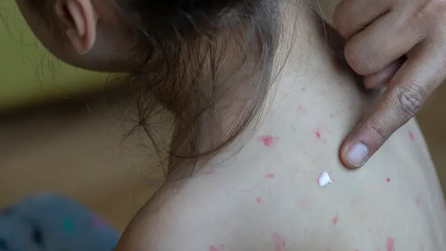 Father taking care of girl with chicken pox.