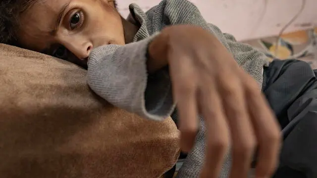 epaselect epa12137107 Five-year-old Palestinian child Osama al-Raqab, who is suffering from severe malnutrition receives treatment at Nasser Hospital in Khan Yunis, southern Gaza Strip, 26 May 2025. EPA/HAITHAM IMAD