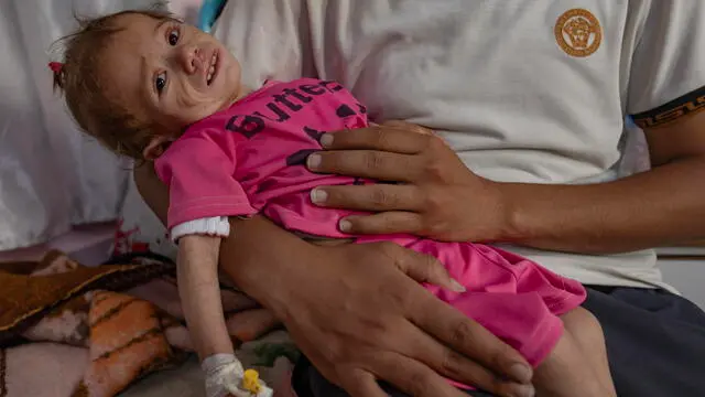 epa12137084 Two-year-old Palestinian girl Maryam Abu Daqqa, who is suffering from malnutrition receives treatment at Nasser Hospital in Khan Yunis, southern Gaza Strip, 26 May 2025. EPA/HAITHAM IMAD