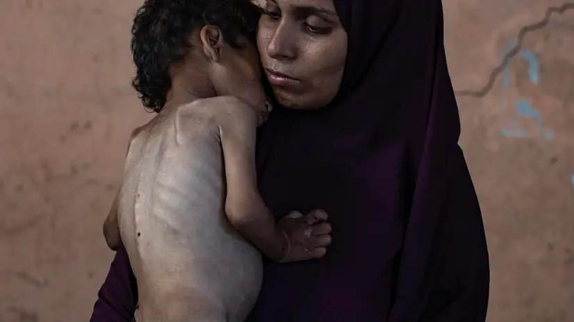 epa12247647 Palestinian child Yazan Abu Foul, aged two, is cared for by his mother Naima, as he suffers from severe malnutrition due to the acute shortage of food caused by the blockade imposed on the Gaza Strip and the closure of border crossings, in Al-Shati refugee camp, west of Gaza City, 19 July 2025. Yazan lives in harsh environmental and health conditions, with his family lacking the basic necessities of life amid a worsening humanitarian crisis. According to medical sources, the child’s health continues to deteriorate due to the lack of proper nutrition and necessary medical care. Humanitarian organizations have warned of an imminent food catastrophe threatening the lives of thousands of children in the besieged Gaza Strip, this situation coming at a time when Gaza’s residents face severe food insecurity and a sharp decline in health services, amid ongoing restrictions on the entry of humanitarian aid and essential supplies. EPA/HAITHAM IMAD