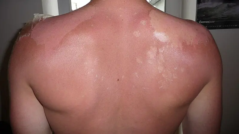 Una scottatura solare - Foto Pavel Ševela / Wikimedia Commons