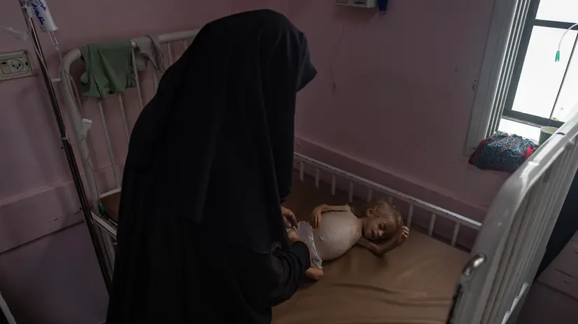 epa12292328 Sham Qudeih, a two-year old Palestinian child, lies on a bed as her mother looks over her at the Nasser Hospital in Khan Younis, southern Gaza Strip, 10 August 2025. Sham Qudeih suffers from liver enlargement, severe malnutrition, and severe abdominal swelling, with her weight having dropped to four kilograms. Doctors at Nasser Hospital in Khan Younis confirmed Sham’s condition is critical and that she urgently needs to leave the Strip to receive treatment abroad. According to the World Health Organization, the malnutrition crisis in Gaza remains dire with a rising number of acutely malnourished children reported since March 2025 coinciding with the onset of the more than 80-day aid blockade. EPA/HAITHAM IMAD