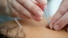 Un trattamento di agopuntura