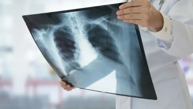 Una radiografia ai polmoni