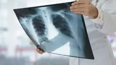 Una radiografia ai polmoni