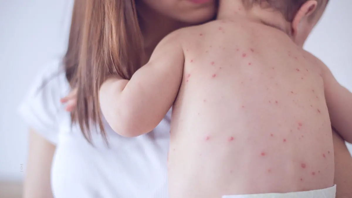 I puntini sulla cute sono il segno più evidente del morbillo