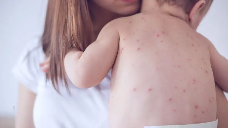 I puntini sulla cute sono il segno più evidente del morbillo