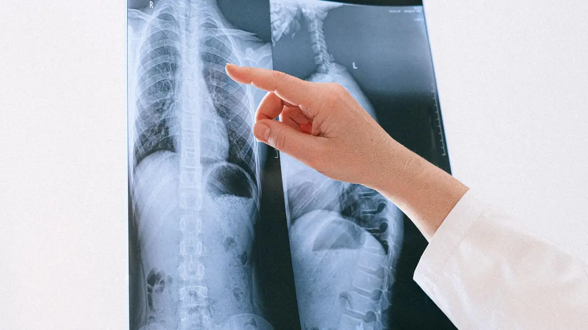 Cellule tumorali possono migrare verso la colonna da un tumore presente in un’altra parte del corpo