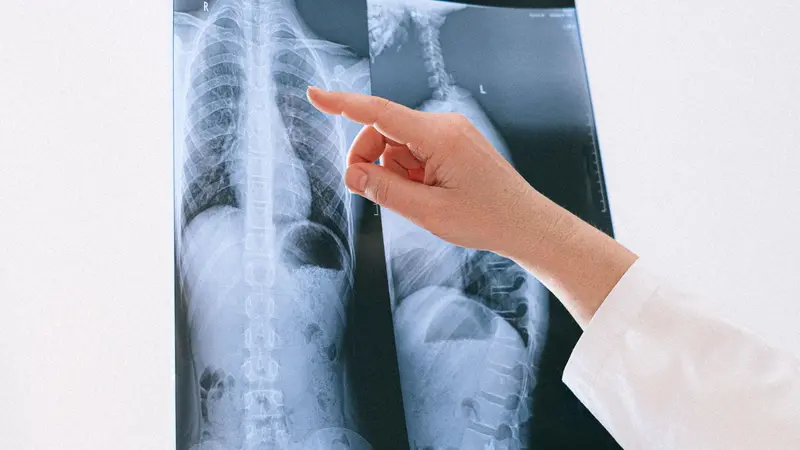 Cellule tumorali possono migrare verso la colonna da un tumore presente in un’altra parte del corpo